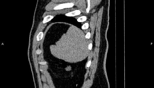 Adrenal myelolipoma (Radiopaedia 84321-99619 Sagittal non-contrast 100).jpg