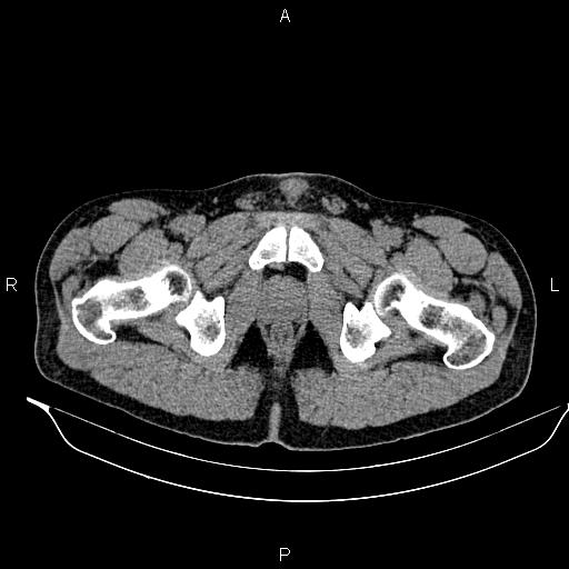Adrenal myelolipoma (Radiopaedia 87794-104246 Axial non-contrast 109).jpg