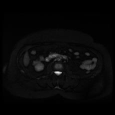 File:Adrenal myelolipoma - MRI (Radiopaedia 83249-97646 Axial STIR 26).jpg