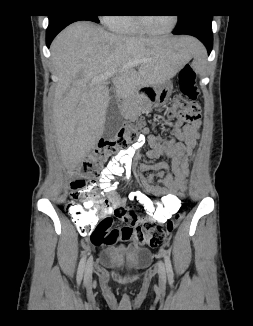 Adrenal myelolipoma - bilateral (Radiopaedia 74805-85810 Coronal C+ portal venous phase 194).jpg