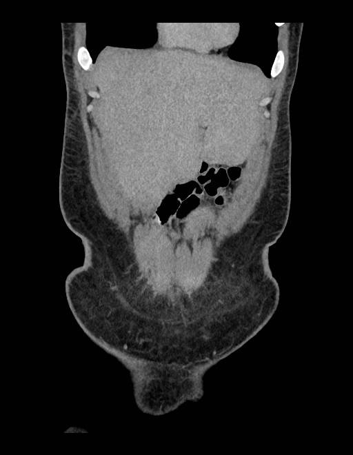 Adrenal myelolipoma - bilateral (Radiopaedia 74805-85810 Coronal C+ portal venous phase 225).jpg