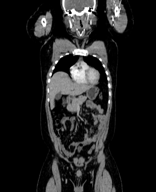 Adrenocortical carcinoma (Radiopaedia 80134-93438 Coronal C+ portal venous phase 54).jpg