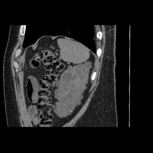 Adult polycystic kidney disease (Radiopaedia 59075-66368 Sagittal non-contrast 79).jpg