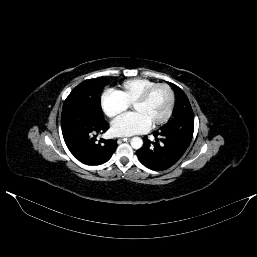 Afferent loop syndrome - secondary to incarcerated trocar site hernia (Radiopaedia 82959-97305 Axial C+ portal venous phase 7).jpg