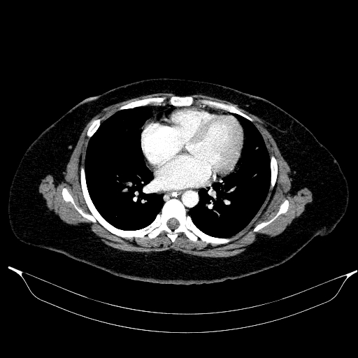 File:Afferent loop syndrome - secondary to incarcerated trocar site hernia (Radiopaedia 82959-97305 Axial C+ portal venous phase 8).jpg