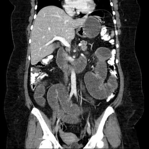File:Afferent loop syndrome - secondary to incarcerated trocar site hernia (Radiopaedia 82959-97305 Coronal C+ portal venous phase 82).jpg