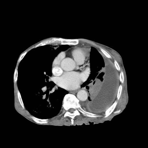 Aggressive lung cancer with cardiac metastases, pulmonary artery tumor thrombus, and Budd-Chiari (Radiopaedia 60320-67981 A 33).jpg