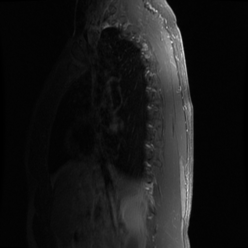 File:Aggressive vertebral hemangioma (Radiopaedia 39937-42404 B 18).png