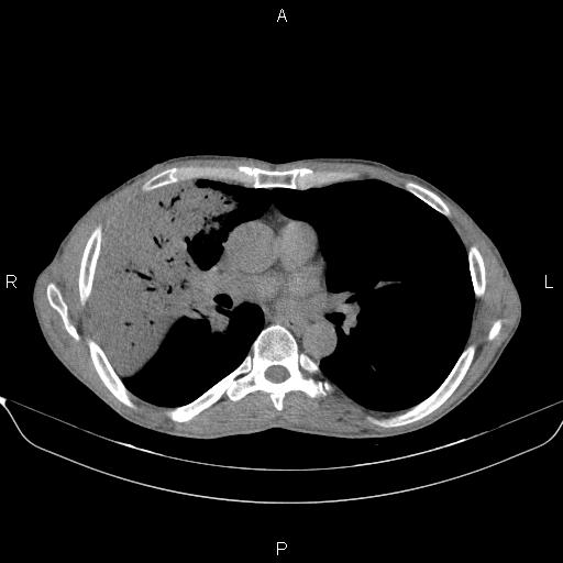 Air bronchogram in pneumonia (Radiopaedia 85719-101512 Axial non-contrast 33).jpg