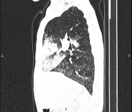 Air bronchogram in pneumonia (Radiopaedia 85719-101512 Sagittal lung window 37).jpg