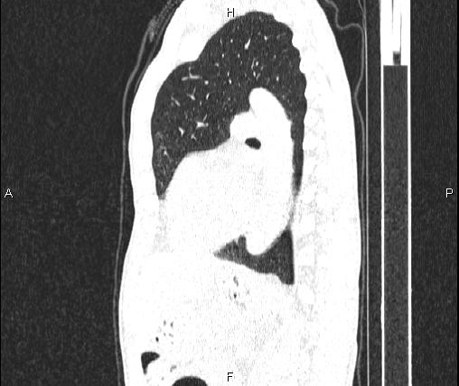 Air bronchogram in pneumonia (Radiopaedia 85719-101512 Sagittal lung window 62).jpg