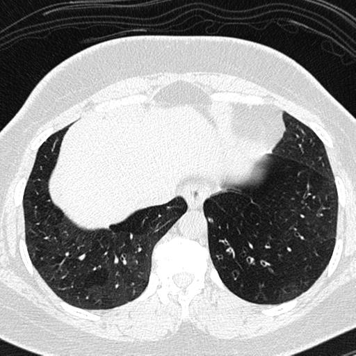 Air trapping in small airway disease (Radiopaedia 61685-69694 Axial lung window 150).jpg