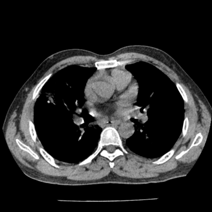 Airway foreign body in adult (Radiopaedia 85907-101779 Axial liver window 86).jpg