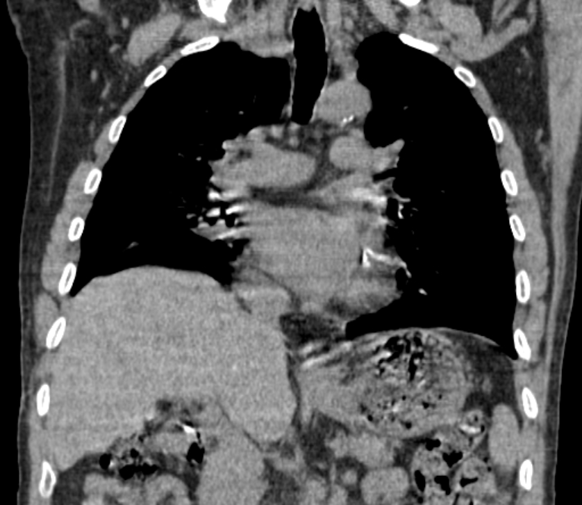 Airway foreign body in adult (Radiopaedia 85907-101779 Coronal liver window 129).jpg