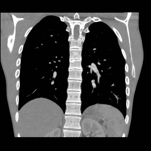 File:Alagille syndrome with pulmonary hypertension (Radiopaedia 49384-54980 C 8).jpg
