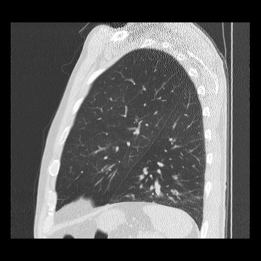 Allergic bronchopulmonary aspergillosis (ABPA) (Radiopaedia 60594-68313 Sagittal lung window 13).jpg