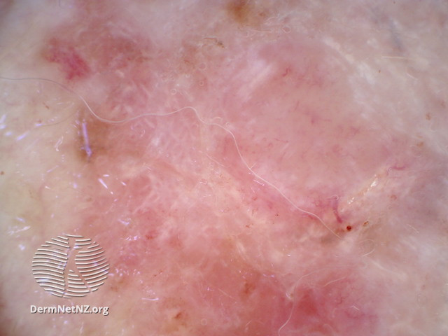 File:Amelanotic melanoma dermoscopy (DermNet NZ amelanotic-melanoma4).jpg