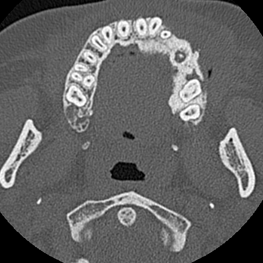 File:Ameloblastic fibro-odontoma (Radiopaedia 18843-18780 C 46).jpg