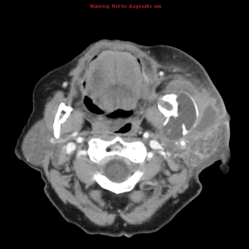 Ameloblastoma (Radiopaedia 27437-27631 A 31).jpg