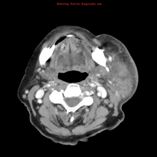Ameloblastoma (Radiopaedia 27437-27631 A 47).jpg