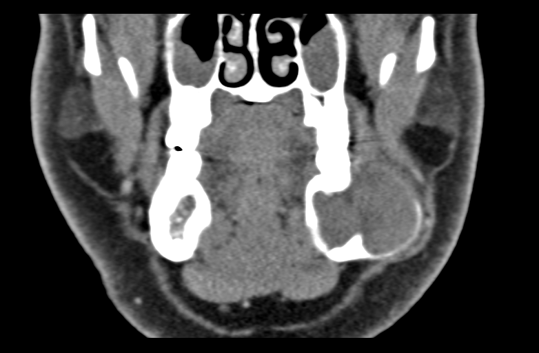 Ameloblastoma (Radiopaedia 33677-34806 Coronal non-contrast 25).png