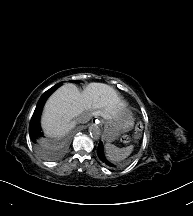 Amiodarone deposition in the liver (Radiopaedia 77587-89780 Axial non-contrast 69).jpg