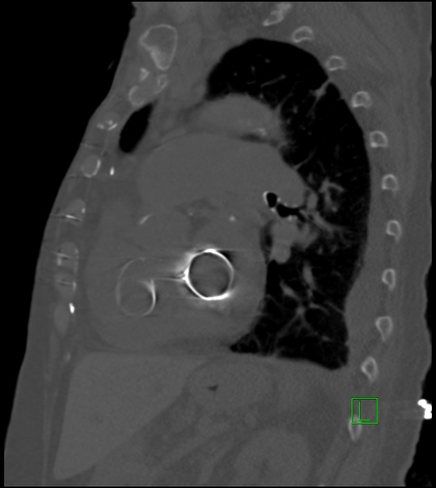 Amiodarone deposition in the liver (Radiopaedia 77587-89780 Sagittal bone window 40).jpg