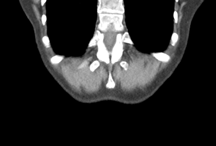 Ampullary adenocarcinoma (Radiopaedia 34013-35241 Coronal 49).png