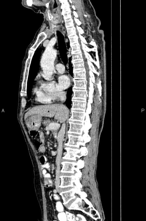 Ampullary adenocarcinoma (Radiopaedia 86093-102033 E 43).jpg