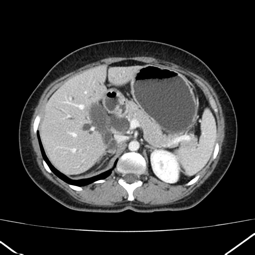 Ampullary tumor (Radiopaedia 22787-22816 C 20).jpg
