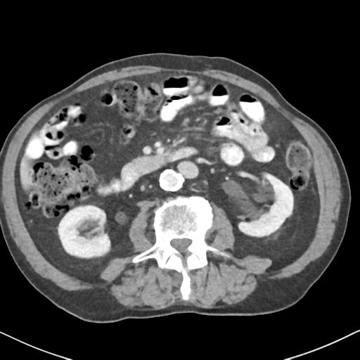 File:Amyand hernia (Radiopaedia 39300-41547 A 31).png