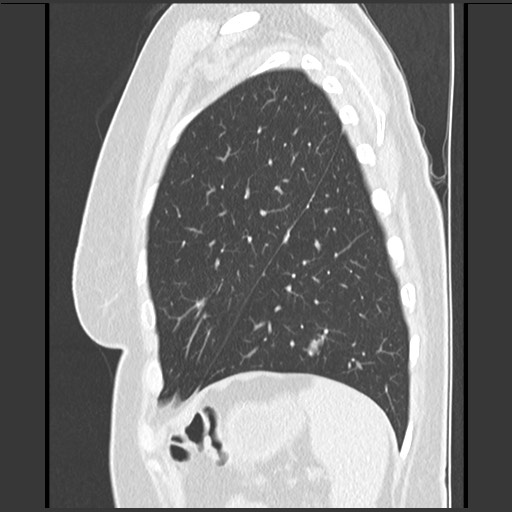File:Amyloidosis - bronchial and diffuse nodular pulmonary involvement (Radiopaedia 60156-67744 F 46).jpg