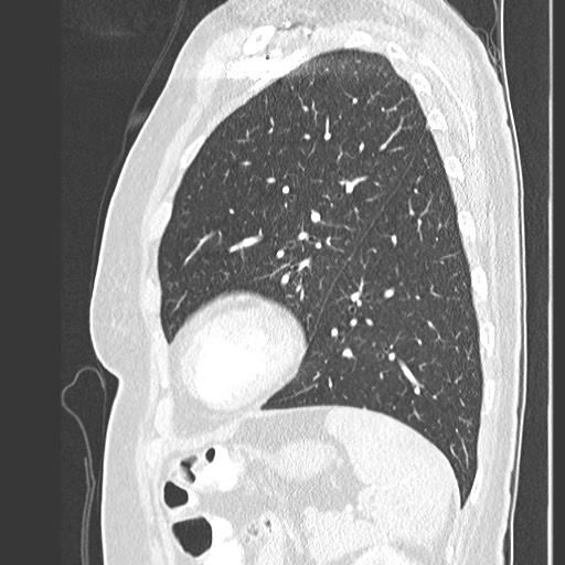Amyloidosis - bronchial and diffuse nodular pulmonary involvement (Radiopaedia 60156-67745 Sagittal lung window 69).jpg