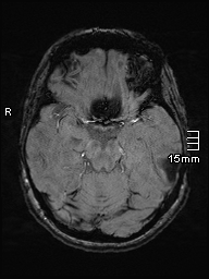 Amyotrophic lateral sclerosis (Radiopaedia 70821-81017 Axial SWI 17).jpg