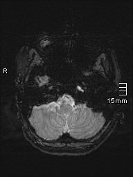 Amyotrophic lateral sclerosis (Radiopaedia 70821-81017 Axial SWI 3).jpg