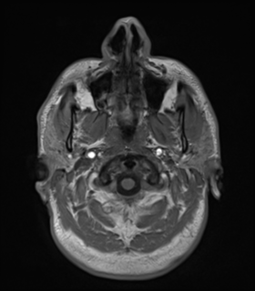 Anaplastic astrocytoma IDH wild-type (Radiopaedia 49984-55273 Axial T1 5).png