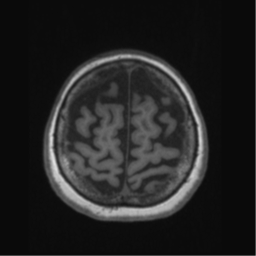 File:Anaplastic astrocytoma IDH wild-type (pseudoprogression) (Radiopaedia 42209-45276 Axial T1 126).png