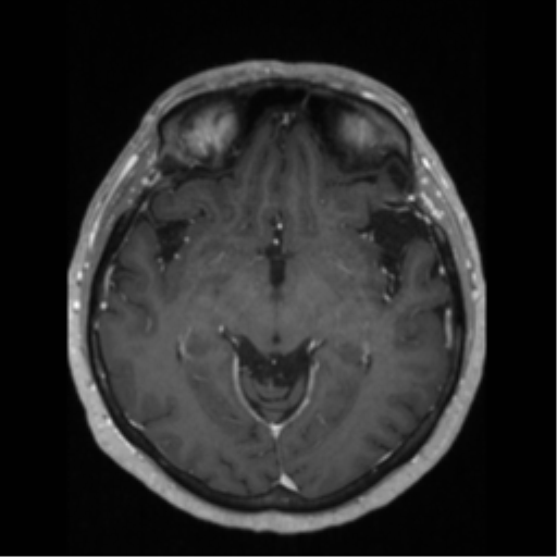 File:Anaplastic astrocytoma IDH wild-type (pseudoprogression) (Radiopaedia 42209-45276 Axial T1 C+ 68).png