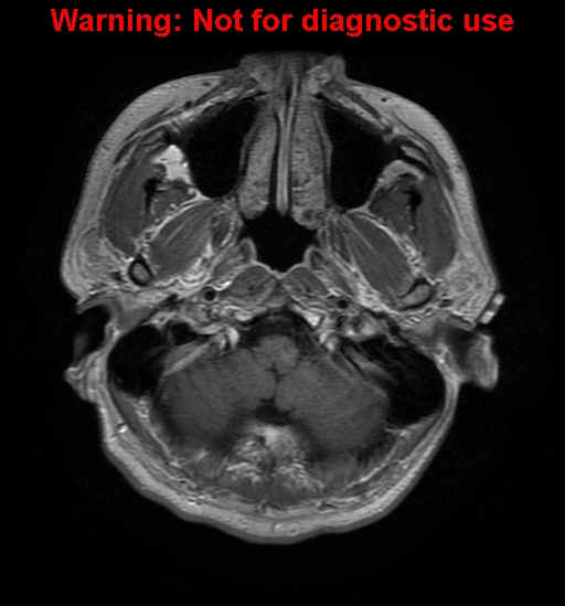 File:Anaplastic ganglioglioma (Radiopaedia 44921-48831 Axial T1 C+ 3).jpg