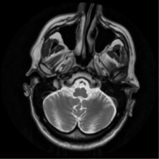 File:Anaplastic meningioma with recurrence (Radiopaedia 34452-35790 Axial T2 5).png