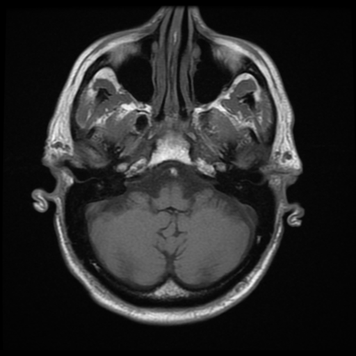 File:Anaplastic meningioma with recurrence (Radiopaedia 34452-35791 Axial T1 4).png