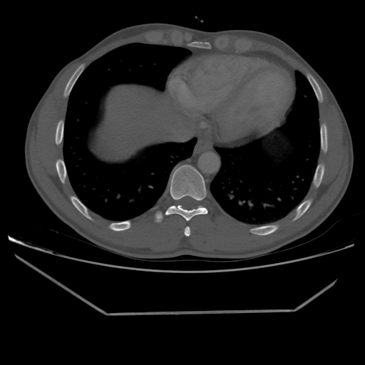 Aneurysmal bone cyst - rib (Radiopaedia 82167-96220 Axial bone window 193).jpg