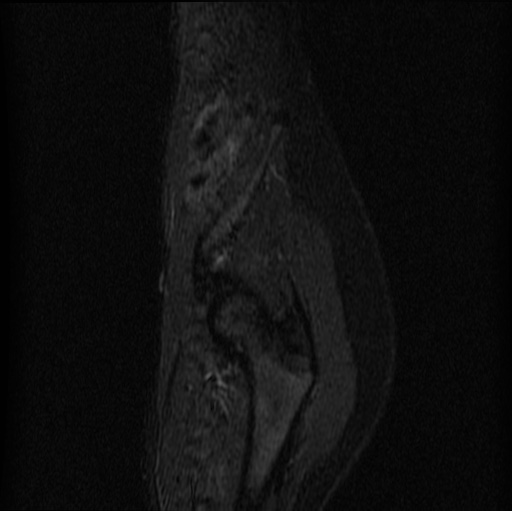 File:Aneurysmal bone cyst - sacrum (Radiopaedia 65190-74196 Sagittal STIR 2).jpg