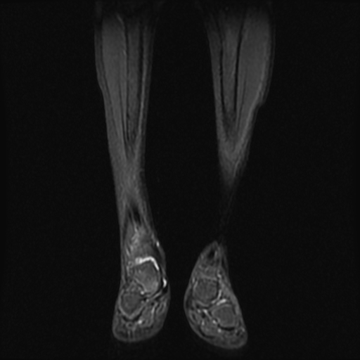 File:Aneurysmal bone cyst - tibia (Radiopaedia 22343-22367 Coronal STIR 5).jpg