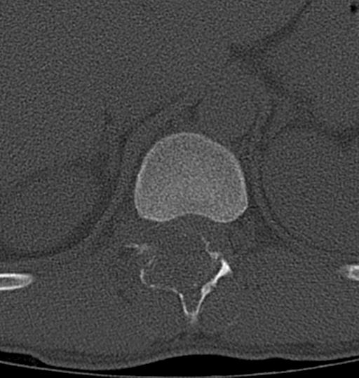 File:Aneurysmal bone cyst T11 (Radiopaedia 29294-29721 Axial bone window 46).jpg