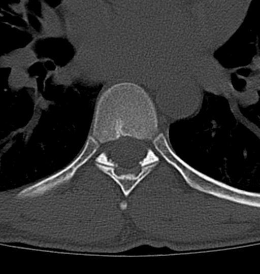 Aneurysmal bone cyst T11 (Radiopaedia 29294-29721 Axial bone window 9).jpg