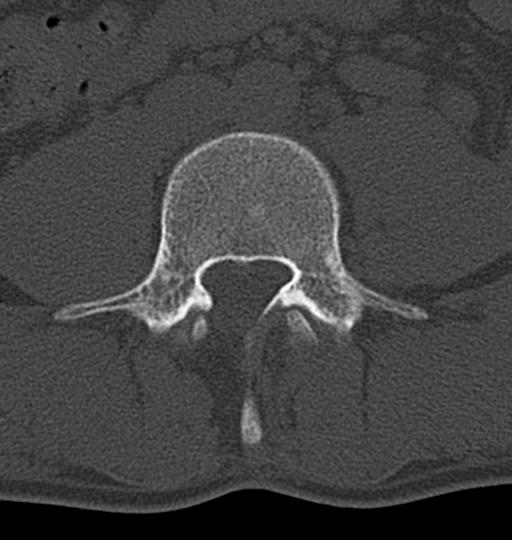 Aneurysmal bone cyst T11 (Radiopaedia 29294-29721 Axial bone window 98).jpg