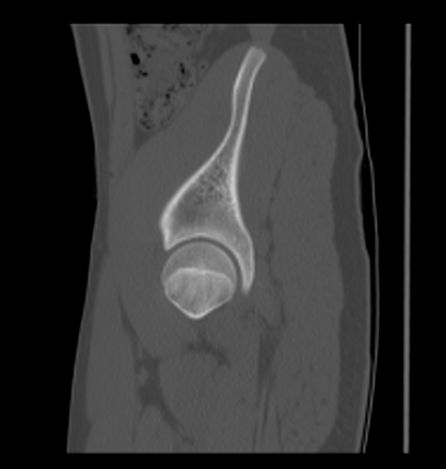 Aneurysmal bone cyst of ischium (Radiopaedia 25957-26094 Sagittal bone window 18).png