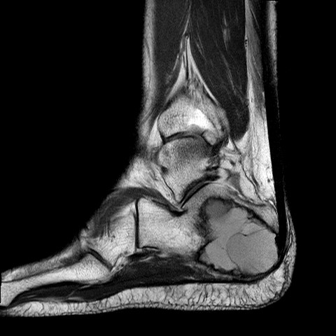 File:Aneurysmal bone cyst of the calcaneus (Radiopaedia 60669-68420 Sagittal PD 6).jpg