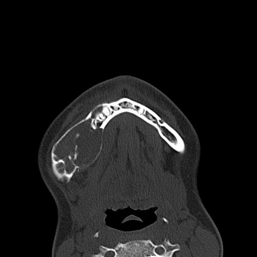 File:Aneurysmal bone cyst of the mandible (Radiopaedia 43280-46601 Axial bone window 11).jpg